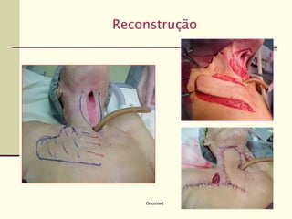 Reconstrução




    Oncomed
 