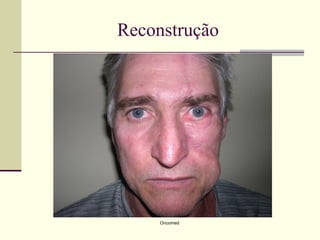 Reconstrução




     Oncomed
 