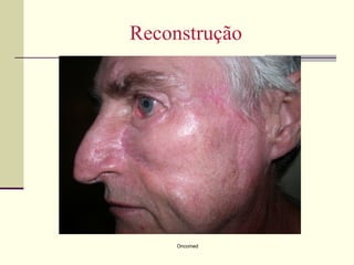 Reconstrução




     Oncomed
 