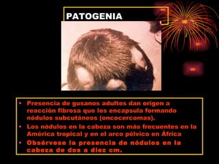 PATOGENIA




• Presencia de gusanos adultos dan origen a
  reacción fibrosa que los encapsula formando
  nódulos subcutáneos (oncocercomas).
• Los nódulos en la cabeza son más frecuentes en la
  América tropical y en el arco pélvico en África
• Obsérvese la presencia de nódulos en la
  cabeza de dos a diez cm.
 