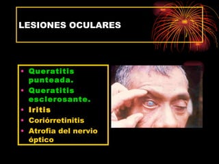 LESIONES OCULARES




• Queratitis
  punteada.
• Queratitis
  esclerosante.
• Iritis
• Coriórretinitis
• Atrofia del nervio
  óptico
 