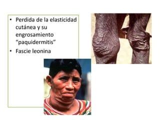 • Perdida de la elasticidad
cutánea y su
engrosamiento
“paquidermitis”
• Fascie leonina

 