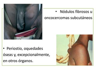 • Nódulos fibrosos u
oncocercomas subcutáneos

• Periostio, oquedades
óseas y, excepcionalmente,
en otros órganos.

 