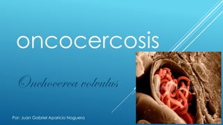 oncocercosis
Onchocerca volvulus
Por: Juan Gabriel Aparicio Noguera
 