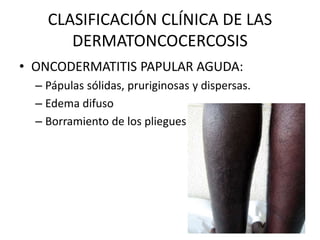 CLASIFICACIÓN CLÍNICA DE LAS
DERMATONCOCERCOSIS
• ONCODERMATITIS PAPULAR AGUDA:
– Pápulas sólidas, pruriginosas y dispersas.
– Edema difuso
– Borramiento de los pliegues cutáneos
 