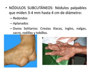 • NÓDULOS SUBCUTÁNEOS: Nódulos palpables
que miden 3-4 mm hasta 4 cm de diámetro:
– Redondos
– Aplanados
– Duros Solitarios: Crestas iliacas, ingles, nalgas,
sacro, rodillas y tobillos.
 