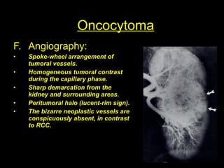 Lucent Rim Sign Oncocytoma | PPT