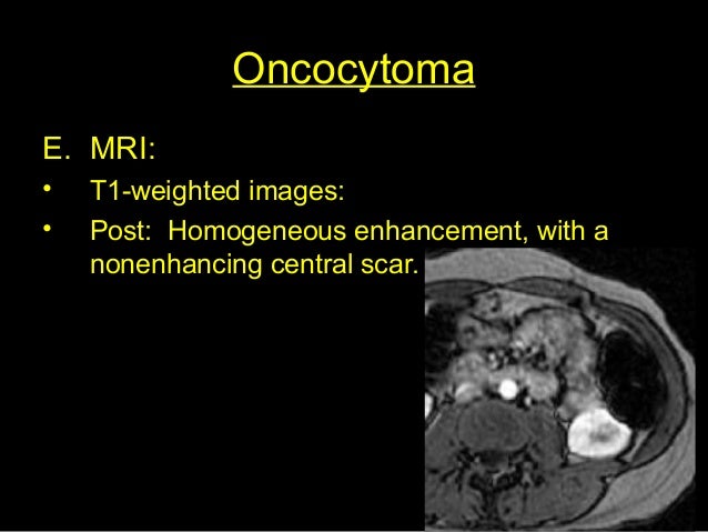 Oncocytoma