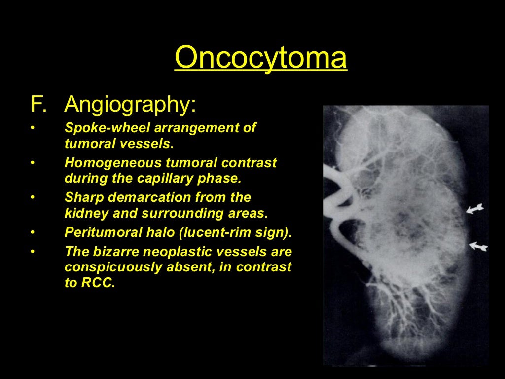 Oncocytoma