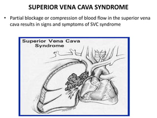 SUPERIOR VENA CAVA SYNDROME
• Partial blockage or compression of blood flow in the superior vena
cava results in signs and symptoms of SVC syndrome
 