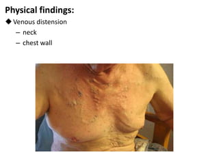 Physical findings:
Venous distension
– neck
– chest wall
 