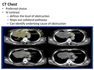 CT Chest
• Preferred choice
• IV contrast
– defines the level of obstruction
– Maps out collateral pathways
– Can identify underlying cause of obstruction
 