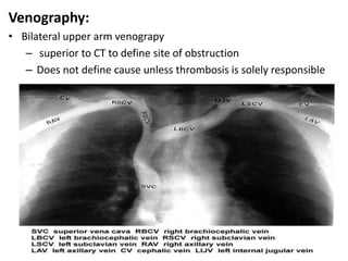 Venography:
• Bilateral upper arm venograpy
– superior to CT to define site of obstruction
– Does not define cause unless thrombosis is solely responsible
 