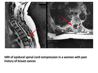 MRI of epidural spinal cord compression in a women with past
history of breast cancer.
 
