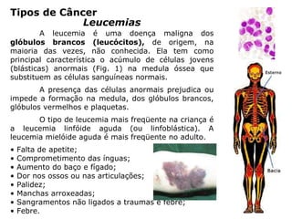 Tipos de Câncer
Leucemias
A leucemia é uma doença maligna dos
glóbulos brancos (leucócitos), de origem, na
maioria das vezes, não conhecida. Ela tem como
principal característica o acúmulo de células jovens
(blásticas) anormais (Fig. 1) na medula óssea que
substituem as células sanguíneas normais.
A presença das células anormais prejudica ou
impede a formação na medula, dos glóbulos brancos,
glóbulos vermelhos e plaquetas.
O tipo de leucemia mais freqüente na criança é
a leucemia linfóide aguda (ou linfoblástica). A
leucemia mielóide aguda é mais freqüente no adulto.
• Falta de apetite;
• Comprometimento das ínguas;
• Aumento do baço e fígado;
• Dor nos ossos ou nas articulações;
• Palidez;
• Manchas arroxeadas;
• Sangramentos não ligados a traumas e febre;
• Febre.
 