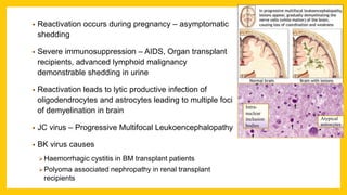 • Reactivation occurs during pregnancy – asymptomatic
shedding
• Severe immunosuppression – AIDS, Organ transplant
recipients, advanced lymphoid malignancy
demonstrable shedding in urine
• Reactivation leads to lytic productive infection of
oligodendrocytes and astrocytes leading to multiple foci
of demyelination in brain
• JC virus – Progressive Multifocal Leukoencephalopathy
• BK virus causes
Haemorrhagic cystitis in BM transplant patients
Polyoma associated nephropathy in renal transplant
recipients
Atypical
astrocytes
Intra-
nuclear
inclusion
bodies
 