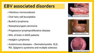 • Infectious mononucleosis
• Oral hairy cell leucoplakia
• Burkitt’s lymphoma
• Nasopharyngeal carcinoma
• Progressive lymphoproliferative disease
• NHL of brain in AIDS patients
• Hodgkin Lymphoma
• Autoimmune diseases – Dermatomyositis, SLE,
RA, Sjögren's syndrome and multiple sclerosis
Oral hairy cell leukoplakia
Burkitt’s Lymphoma
Nasopharyngeal Carcinoma
EBV associated disorders
 