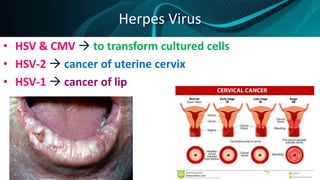 Herpes Virus
• HSV & CMV  to transform cultured cells
• HSV-2  cancer of uterine cervix
• HSV-1  cancer of lip
 