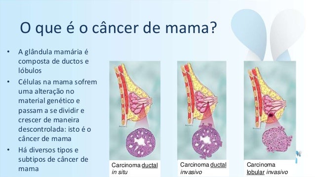 tratamento para carcinoma ductal in situ tratamento para carcinoma ductal in situ