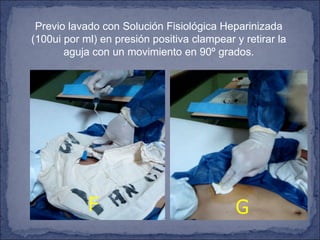 Previo lavado con Solución Fisiológica Heparinizada (100ui por ml) en presión positiva clampear y retirar la aguja con un movimiento en 90º grados. F G 