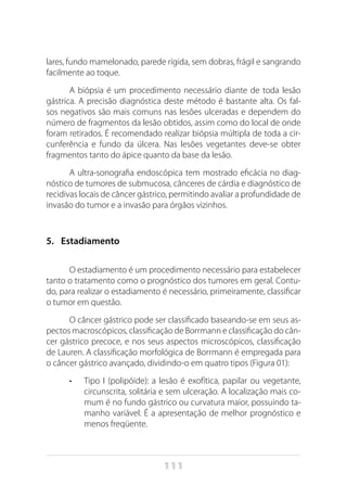 111
lares, fundo mamelonado, parede rígida, sem dobras, frágil e sangrando
facilmente ao toque.
A biópsia é um procedimento necessário diante de toda lesão
gástrica. A precisão diagnóstica deste método é bastante alta. Os fal-
sos negativos são mais comuns nas lesões ulceradas e dependem do
número de fragmentos da lesão obtidos, assim como do local de onde
foram retirados. É recomendado realizar biópsia múltipla de toda a cir-
cunferência e fundo da úlcera. Nas lesões vegetantes deve-se obter
fragmentos tanto do ápice quanto da base da lesão.
A ultra-sonografia endoscópica tem mostrado eficácia no diag-
nóstico de tumores de submucosa, cânceres de cárdia e diagnóstico de
recidivas locais de câncer gástrico, permitindo avaliar a profundidade de
invasão do tumor e a invasão para órgãos vizinhos.
5.	 Estadiamento
O estadiamento é um procedimento necessário para estabelecer
tanto o tratamento como o prognóstico dos tumores em geral. Contu-
do, para realizar o estadiamento é necessário, primeiramente, classificar
o tumor em questão.
O câncer gástrico pode ser classificado baseando-se em seus as-
pectos macroscópicos, classificação de Borrmann e classificação do cân-
cer gástrico precoce, e nos seus aspectos microscópicos, classificação
de Lauren. A classificação morfológica de Borrmann é empregada para
o câncer gástrico avançado, dividindo-o em quatro tipos (Figura 01):
•	 Tipo I (polipóide): a lesão é exofítica, papilar ou vegetante,
circunscrita, solitária e sem ulceração. A localização mais co-
mum é no fundo gástrico ou curvatura maior, possuindo ta-
manho variável. É a apresentação de melhor prognóstico e
menos freqüente.
 