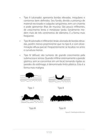 112
•	 Tipo II (ulcerado): apresenta bordas elevadas, irregulares e
contornos bem definidos. Seu fundo, devido a presença de
material necrosado e coágulos sangüíneos, tem cor cinzenta
e pode apresentar ilhas de mucosa. São pouco infiltrantes,
de crescimento lento e metástase tardia. Geralmente me-
dem mais de três centímetros de diâmetro. É a forma mais
freqüente.
•	 Tipo III (ulcerado e infiltrante): lesão ulcerada de bordas eleva-
das, porém menos proeminente que no tipo II, e com disse-
minação difusa parcial. Freqüentemente se localiza no antro
e curvatura menor.
•	 Tipo IV (difusa): são tumores de grande crescimento pela
submucosa e serosa. Quando infiltrar extensamente a parede
gástrica, sem se concentrar em um local, tornando rígidas as
paredes do estômago, é denominado linitis plástica. Esta é a
forma mais maligna.
Tipo I Tipo II
Tipo III Tipo IV
Figura 01: Classificação de Borrman.
 