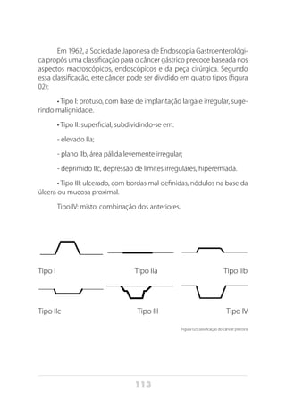 113
Em 1962, a Sociedade Japonesa de Endoscopia Gastroenterológi-
ca propôs uma classificação para o câncer gástrico precoce baseada nos
aspectos macroscópicos, endoscópicos e da peça cirúrgica. Segundo
essa classificação, este câncer pode ser dividido em quatro tipos (figura
02):
• Tipo I: protuso, com base de implantação larga e irregular, suge-
rindo malignidade.
• Tipo II: superficial, subdividindo-se em:
- elevado IIa;
- plano IIb, área pálida levemente irregular;
- deprimido IIc, depressão de limites irregulares, hiperemiada.
• Tipo III: ulcerado, com bordas mal definidas, nódulos na base da
úlcera ou mucosa proximal.
Tipo IV: misto, combinação dos anteriores.
Tipo I Tipo IIa Tipo IIb
Tipo IIc Tipo III Tipo IV
Figura 02:Classificação do câncer precoce
 