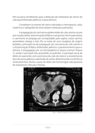 155
têm acurácia semelhantes para a detecção de metástases de câncer de
colo para linfonodos pélvicos e para-aórticos.
Completam os exames de rotina solicitados o hemograma, uréia,
creatinina e radiografia de tórax (afastar metástase pulmonar).
A propagação do carcinoma epidermóide de colo uterino ocorre
por invasão direta, disseminação linfática e sanguínea. Na invasão direta,
o carcinoma se propaga por contigüidade para vagina, corpo uterino,
paramétrios, bexiga e reto. Por se tratar de uma neoplasia de origem
epitelial, a principal via de propagação do carcinoma de colo uterino é
a disseminação linfática (linfonodos pélvicos e posteriormente para-a-
órticos). A propagação por via hematogênica é pouco comum (Figura
1), sendo o principal sítio acometido os pulmões. A principal causa de
óbito em pacientes com carcinoma do colo do útero é o envolvimento
das estruturas pélvicas, sobretudo do ureter, determinando insuficiência
renal obstrutiva. Outras causas de óbito são hemorragias não possíveis
de tratamento, infecção e fístulas.
Figura 1: Metástase hepática de tumor do colo do útero.
 