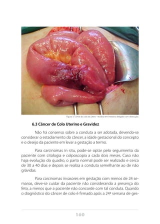 160
Figura 3: Tumor do colo do útero - recidiva em intestino delgado com obstrução.
6.3 Câncer de Colo Uterino e Gravidez
	 Não há consenso sobre a conduta a ser adotada, devendo-se
considerar o estadiamento do câncer, a idade gestacional do concepto
e o desejo da paciente em levar a gestação a termo.
	 Para carcinomas in situ, pode-se optar pelo seguimento da
paciente com citologia e colposcopia a cada dois meses. Caso não
haja evolução do quadro, o parto normal pode ser realizado e cerca
de 30 a 40 dias e depois se realiza a conduta semelhante ao de não
grávidas.
	 Para carcinomas invasores em gestação com menos de 24 se-
manas, deve-se cuidar da paciente não considerando a presença do
feto, a menos que a paciente não concorde com tal conduta. Quando
o diagnóstico do câncer de colo é firmado após a 24ª semana de ges-
 