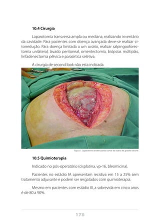 178
10.4 Cirurgia
Laparotomia transversa ampla ou mediana, realizando inventário
da cavidade. Para pacientes com doença avançada deve-se realizar ci-
torredução. Para doença limitada a um ovário, realizar salpingooforec-
tomia unilateral, lavado peritoneal, omentectomia, biópsias múltiplas,
linfadenectomia pélvica e paraórtica seletiva.
A cirurgia de second look não esta indicada.
Figura 1: Laparotomia evidenciando tumor de ovário de grande volume.
10.5 Quimioterapia
Indicado no pós-operatório (cisplatina, vp-16, bleomicina).
Pacientes no estádio IA apresentam recidiva em 15 a 25% sem
tratamento adjuvante e podem ser resgatados com quimioterapia.
Mesmo em pacientes com estádio III, a sobrevida em cinco anos
é de 80 a 90%.
 