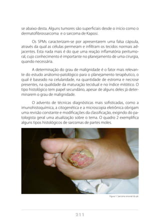 211
se abaixo desta. Alguns tumores são superficiais desde o início como o
dermatofibrossarcoma e o sarcoma de Kaposi.
Os SPMs caracterizam-se por apresentarem uma falsa cápsula,
através da qual as células permeiam e infiltram os tecidos normais ad-
jacentes. Esta nada mais é do que uma reação inflamatória peritumo-
ral, cujo conhecimento é importante no planejamento de uma cirurgia,
quando necessária.
A determinação do grau de malignidade é o fator mais relevan-
te do estudo anátomo-patológico para o planejamento terapêutico, o
qual é baseado na celularidade, na quantidade de estroma e necrose
presentes, na qualidade da maturação tecidual e no índice mitótico. O
tipo histológico tem papel secundário, apesar de alguns deles já deter-
minarem o grau de malignidade.
O advento de técnicas diagnósticas mais sofisticadas, como a
imunohistoquímica, a citogenética e a microscopia eletrônica obrigam
uma revisão constante e modificações da classificação, exigindo do pa-
tologista geral uma atualização sobre o tema. O quadro 2 exemplifica
alguns tipos histológicos de sarcomas de partes moles.
Figura 1: Sarcoma sinovial do pé.
 