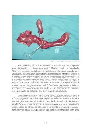 73
Figura 1: Produto de gastroduodenopancreatectomia.
Antigamente, técnica minimamente invasiva era usada apenas
para diagnóstico do câncer pancreático. Desde o início da década de
90, as técnicas laparoscópicas vem evoluindo e, na última década, a re-
alização da duodenopancreatectomia laparoscópica é factível, segura e
benéfica. Além das vantagens da cirurgia laparoscópica, como redução
da dor e sangramento no pós-operatório, menor tempo de internação e
retorno precoce ao trabalho, a incidência de atelectasia e pneumonia é
menor que na cirurgia convencional. A Duodenopancreatectomia lapa-
roscópica com reconstrução, apesar de ser um procedimento demora-
do, é possível e pode tornar-se a técnica padrão no futuro.
O fato de o tumor primário poder ser ressecado cirurgicamente é
o fator prognóstico mais importante para essa doença e constitui a base
da distinção entre os estádios I e II (ressecável) e estádios III e IV (irresse-
cável). Pacientes com tumores irressecáveis representam a maioria dos
diagnósticos de câncer de pâncreas e apresentam uma sobrevida uni-
formemente baixa. Esses pacientes são geralmente tratados com uma
 