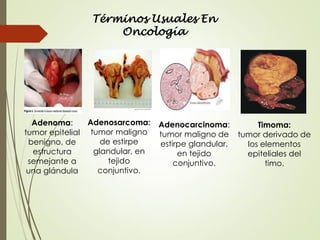 Adenosarcoma:
tumor maligno
de estirpe
glandular, en
tejido
conjuntivo.
Adenoma:
tumor epitelial
benigno, de
estructura
semejante a
una glándula
Adenocarcinoma:
tumor maligno de
estirpe glandular,
en tejido
conjuntivo.
Timoma:
tumor derivado de
los elementos
epiteliales del
timo.
Términos Usuales En
Oncología
 