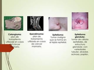 Ependimoma:
plan de
tratamiento
utilizado en casos
de cáncer
mamario.
Colangioma:
plan de
tratamiento
utilizado en casos
de cáncer
mamario.
Epitelioma
glandular.
tumor de células
epiteliales, de
estructura
glandular, con
variedades
tubular, alveolar,
acinosa, papilar..
Epitelioma:
Tumor maligno
que se forma en
el tejido epitelial.
 