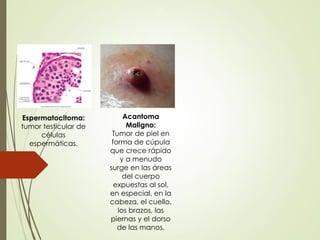 Acantoma
Maligno:
Tumor de piel en
forma de cúpula
que crece rápido
y a menudo
surge en las áreas
del cuerpo
expuestas al sol,
en especial, en la
cabeza, el cuello,
los brazos, las
piernas y el dorso
de las manos.
Espermatocitoma:
tumor testicular de
células
espermáticas.
 