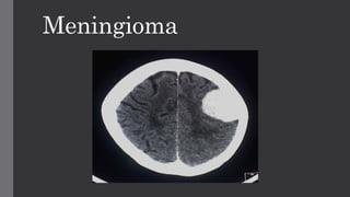 Meningioma
 