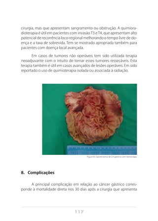 117
cirurgia, mas que apresentam sangramento ou obstrução. A quimiora-
dioterapia é útil em pacientes com invasão T3 e T4, que apresentam alto
potencial de recorrência loco-regional melhorando o tempo livre de do-
ença e a taxa de sobrevida. Tem se mostrado apropriada também para
pacientes com doença local avançada.
Em casos de tumores não operáveis tem sido utilizada terapia
neoadjuvante com o intuito de tornar esses tumores ressecáveis. Esta
terapia também é útil em casos avançados de lesões operáveis. Em sido
reportado o uso de quimioterapia isolada ou associada à radiação.
Figura 03: Gastrectomia de CA gástrico com hemorragia.
8.	 Complicações
A principal complicação em relação ao câncer gástrico corres-
ponde à mortalidade direta nos 30 dias após a cirurgia que apresenta
 