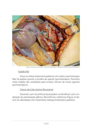 159
Figura 2: Tumor do colo do útero – linfonodectomia pélvica- linfonodo sentinela corado de azul patente.
Estádio IVb:
	 Deve-se utilizar tratamento paliativo com radio e quimioterapia.
Não há padrão quanto à escolha do agente quimioterápico. Pacientes
neste estádio são candidatos para ensaios clínicos de novos agentes
quimioterápicos.
	 Câncer de Colo Uterino Recorrente:
	 Pacientes com recorrência local podem se beneficiar com a re-
alização da exenteração pélvica. Recorrências sistêmicas (Figura 3) de-
vem ser abordadas com tratamento radioquimioterápico paliativo.
 