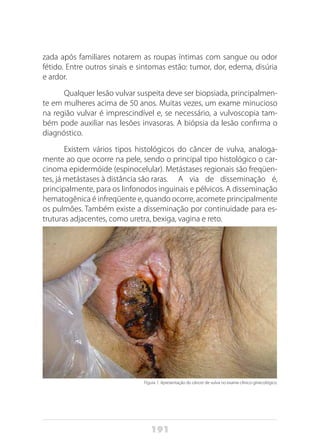 191
zada após familiares notarem as roupas íntimas com sangue ou odor
fétido. Entre outros sinais e sintomas estão: tumor, dor, edema, disúria
e ardor.
Qualquer lesão vulvar suspeita deve ser biopsiada, principalmen-
te em mulheres acima de 50 anos. Muitas vezes, um exame minucioso
na região vulvar é imprescindível e, se necessário, a vulvoscopia tam-
bém pode auxiliar nas lesões invasoras. A biópsia da lesão confirma o
diagnóstico.
Existem vários tipos histológicos do câncer de vulva, analoga-
mente ao que ocorre na pele, sendo o principal tipo histológico o car-
cinoma epidermóide (espinocelular). Metástases regionais são freqüen-
tes, já metástases à distância são raras. 	 A via de disseminação é,
principalmente, para os linfonodos inguinais e pélvicos. A disseminação
hematogênica é infreqüente e, quando ocorre, acomete principalmente
os pulmões. Também existe a disseminação por continuidade para es-
truturas adjacentes, como uretra, bexiga, vagina e reto.
Figura 1: Apresentação do câncer de vulva no exame clínico-ginecológico.
 