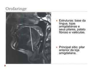 Orofaringe
 Estruturas: base da
língua, lojas
amigdalianas e
seus pilares, palato
fibroso e valéculas.
 Principal sítio: pilar
anterior da loja
amigdaliana.
 