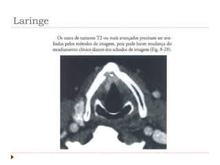 Laringe
 