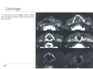 Laringe
 