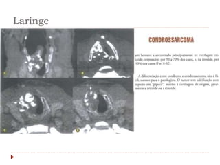 Laringe
 