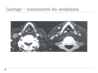 Laringe – tratamento da neoplasia
 
