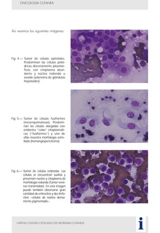 Asi veremos las siguientes imágenes:
CAPITULO I ESTUDIO CITOLOGICO DE NEOPLASIAS CUTANEAS
ONCOLOGIA CUTANEA
i
Fig. 4.— Tumor de células epiteliales.
Predominan las células polié-
dricas discretamente pleomór-
ficas, con citoplasma abun-
dante y núcleo redondo u
ovoide (adenoma de glándulas
hepatoides).
Fig. 5.— Tumor de células fusiformes
(mesenquimatosas). Predomi-
nan las células alargadas con
evidentes “colas” citoplasmáti-
cas (“fusiformes”) y una de
ellas muestra morfología estre-
llada (hemangiopericitoma).
Fig. 6.— Tumor de células redondas. Las
células se encuentran sueltas y
presentan núcleo y citoplasma de
morfología redonda (Tumor vené-
reo transmisible). En esta imagen
puede también observarse gran
cantidad de eritrocitos y dos linfo-
citos –células de núcleo densa-
mente pigmentado–.
 