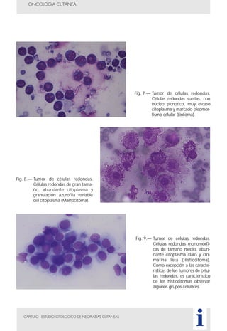 CAPITULO I ESTUDIO CITOLOGICO DE NEOPLASIAS CUTANEAS
ONCOLOGIA CUTANEA
i
Fig. 7.— Tumor de células redondas.
Células redondas sueltas, con
núcleo picnótico, muy escaso
citoplasma y marcado pleomor-
fismo celular (Linfoma).
Fig. 8.— Tumor de células redondas.
Células redondas de gran tama-
ño, abundante citoplasma y
granulación azurófila variable
del citoplasma (Mastocitoma).
Fig. 9.— Tumor de células redondas.
Células redondas monomórfi-
cas de tamaño medio, abun-
dante citoplasma claro y cro-
matina laxa (Histiocitoma).
Como excepción a las caracte-
rísticas de los tumores de célu-
las redondas, es característico
de los histiocitomas observar
algunos grupos celulares.
 