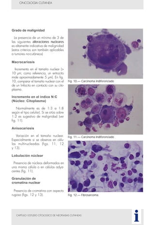 CAPITULO I ESTUDIO CITOLOGICO DE NEOPLASIAS CUTANEAS
ONCOLOGIA CUTANEA
i
Fig. 10.— Carcinoma Indiferenciado
Fig. 11.— Carcinoma Indiferenciado
Grado de malignidad
La presencia de un mínimo de 3 de
las siguientes alteraciones nucleares
es altamente indicativa de malignidad
(estos criterios son también aplicables
a tumores no-cutáneos)
Macrocariosis
Incremento en el tamaño nuclear (>
10 µm; como referencia, un eritrocito
mide aproximadamente 5 µm). En fig.
10, comparar el tamaño nuclear con el
de un linfocito en contacto con su cito-
plasma.
Incremento en el índice N:C
(Núcleo: Citoplasma)
Normalmente es de 1:3 a 1:8
según el tipo celular). Si se sitúa sobre
1:2 es sugestivo de malignidad (ver
fig. 11).
Anisocariosis
Variación en el tamaño nuclear.
Especialmente si se observa en célu-
las multinucleadas (figs. 11, 12
y 13).
Lobulación núclear
Presencia de núcleos deformados en
una misma célula o en células adya-
centes (fig. 11).
Granulación de
cromatina nuclear
Presencia de cromatina con aspecto
rugoso (figs. 12 y 13). Fig. 12.— Fibrosarcoma.
 