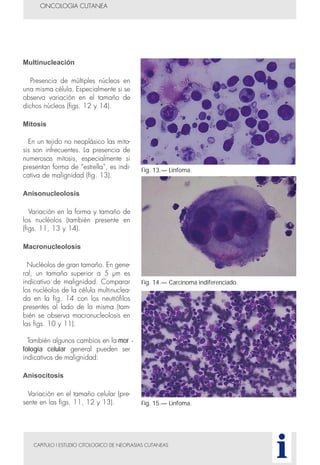 CAPITULO I ESTUDIO CITOLOGICO DE NEOPLASIAS CUTANEAS
ONCOLOGIA CUTANEA
i
Multinucleación
Presencia de múltiples núcleos en
una misma célula. Especialmente si se
observa variación en el tamaño de
dichos núcleos (figs. 12 y 14).
Mitosis
En un tejido no neoplásico las mito-
sis son infrecuentes. La presencia de
numerosas mitosis, especialmente si
presentan forma de “estrella”, es indi-
cativa de malignidad (fig. 13).
Anisonucleolosis
Variación en la forma y tamaño de
los nucléolos (también presente en
(figs. 11, 13 y 14).
Macronucleolosis
Nucléolos de gran tamaño. En gene-
ral, un tamaño superior a 5 µm es
indicativo de malignidad. Comparar
los nucléolos de la célula multinuclea-
da en la fig. 14 con los neutrófilos
presentes al lado de la misma (tam-
bién se observa macronucleolosis en
las figs. 10 y 11).
También algunos cambios en la mor -
fología celular general pueden ser
indicativos de malignidad:
Anisocitosis
Variación en el tamaño celular (pre-
sente en las figs. 11, 12 y 13).
Fig. 13.— Linfoma.
Fig. 14.— Carcinoma indiferenciado.
Fig. 15.— Linfoma.
 