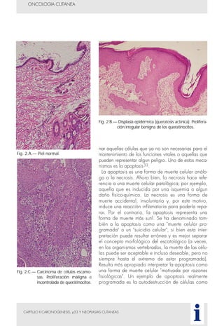 nar aquellas células que ya no son necesarias para el
mantenimiento de las funciones vitales o aquellas que
pueden representar algun peligro. Uno de estos meca-
nismos es la apoptosis33.
La apoptosis es una forma de muerte celular análo-
ga a la necrosis. Ahora bien, la necrosis hace refe-
rencia a una muerte celular patológica; por ejemplo,
aquella que es inducida por una isquemia o algun
daño físico-químico. La necrosis es una forma de
muerte accidental, involuntaria y, por este motivo,
induce una reacción inflamatoria para poderla repa-
rar. Por el contrario, la apoptosis representa una
forma de muerte más sutil. Se ha denominado tam-
bién a la apoptosis como una "muerte celular pro-
gramada" o un "suicidio celular", si bien esta inter-
pretación puede resultar errónea y es mejor separar
el concepto morfológico del escatológico (a veces,
en los organismos vertebrados, la muerte de las célu-
las puede ser aceptable e incluso deseable, pero no
siempre hasta el extremo de estar programada).
Resulta más apropiado interpretar la apoptosis como
una forma de muerte celular "motivada por razones
fisiológicas". Un ejemplo de apoptosis realmente
programada es la autodestrucción de células como
CAPITULO II CARCINOGENESIS, p53 Y NEOPLASIAS CUTANEAS
ONCOLOGIA CUTANEA
i
Fig. 2.A.— Piel normal.
Fig. 2.B.— Displasia epidérmica (queratosis actínica). Prolifera-
ción irregular benigna de los queratinocitos.
Fig. 2.C.— Carcinoma de células escamo-
sas. Proliferación maligna e
incontrolada de queratinocitos.
 
