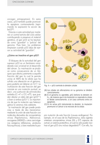 CAPITULO II CARCINOGENESIS, p53 Y NEOPLASIAS CUTANEAS
oncogen antiapoptosis). En estos
casos, p53 también puede promover
la apoptosis contrarrestando (repri-
miendo la expresión) la acción de
bcl-220.
Gracias a esta actividad por mante-
ner un control estricto del ciclo celular
contribuyendo a preservar el material
genético, el gen p53 se ha bautiza-
do como "guardián" o "policía" del
genoma. Pues bien, los problemas
empiezan cuando p53 deja de ejer-
cer su actividad de "guardián".
¿Cómo se inactiva el gen p53?
El bloqueo de la actividad del gen
supresor p53 es un fenómeno consi-
derado casi universal en el desarrollo
del cáncer. Su inactivación se produ-
ce como consecuencia de un blo-
queo que afecta justamente a aquella
fracción del gen la cual le permite
unirse al ADN de la célula que ha
sufrido una alteración en el genoma,
para poderla así detener en G12. La
inutilización de esta fracción del gen
consiste en una mutación puntual, es
decir, una sustitución de aminoácidos
aislados (C→T o CC→TT), que pue-
den afectar un alelo del gen (p53+/-)
o bien a ambos (p53-/-). La importan-
cia de que la mutación sea heteroci-
gótica la veremos más adelante.
La inactivación del gen puede produ-
cirse a través de dos mecanismos:
mediante la unión de esta fracción con
moléculas derivadas de oncoproteínas
víricas (Papilomavirus, Adenovirus),
oncogenes (MDM2) u otros carcinóge-
nos exógenos (aflatoxinas, productos
físico-químicos), o bien mediante la pro-
pia mutación de esta fracción (causas endógenas). Por
ejemplo, en el caso de los Papilomavirus, estos agentes
sintetizan oncoproteínas víricas (E6 y E7) capaces de
activar un sistema proteolítico, el cual no sólo puede inac-
tivar el gen p53 sino incluso degradarlo34. Con ello, los
ONCOLOGIA CUTANEA
i
Fig. 4.— p53 controla la división celular.
(A) Las células sin alteraciones en su genoma se dividen
correctamente.
(B) Si el genoma es agredido, p53 detiene la división en
G1, de manera que si la mutación es reparada la célula
se divide correctamente, o en caso contrario entra en
apoptosis.
(C) Si no actúa p53 deteniendo la división, la mutación
promueve el cáncer o la necrosis de la célula.
 